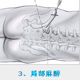 采取局部麻醉方式進(jìn)行麻醉