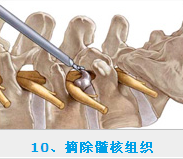 椎間孔鏡價(jià)格怎么樣