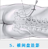 椎間孔鏡 王先明