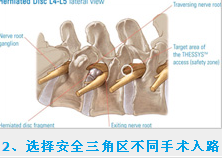 椎間孔鏡安全三角區(qū)