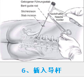 椎間孔鏡術(shù)后護(hù)理