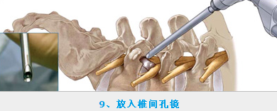 椎間孔鏡多少錢(qián)