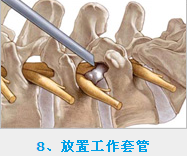 椎間孔鏡射頻電極